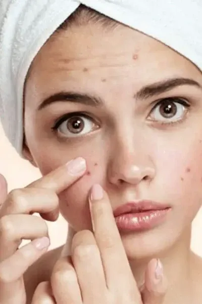 Acne Marks