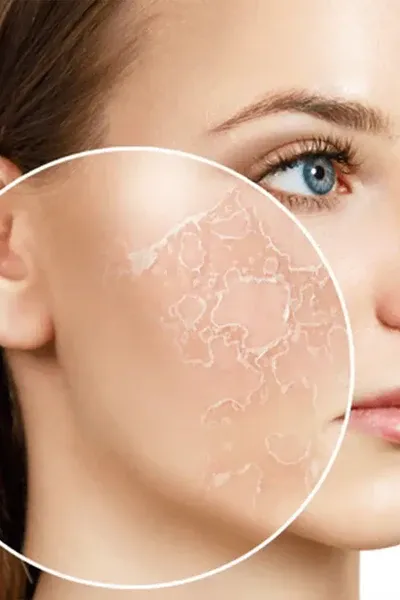 Dry Skin