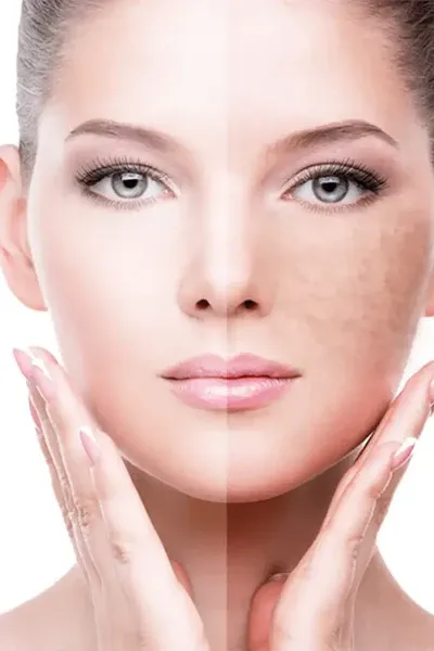 Pigmentation