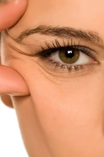 Wrinkles